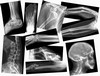 Broken Bones X-Rays